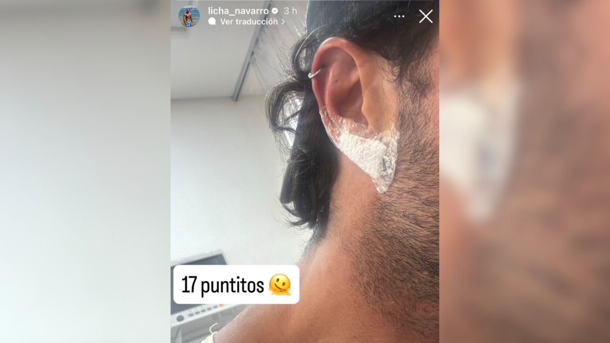 A trav&eacute;s de sus redes sociales, Licha de Gran Hermano mostr&oacute; c&oacute;mo qued&oacute; su oreja.