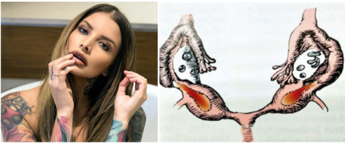 Miller no solo tiene dos vaginas: tiene dos úteros y dos juegos de ovarios. La usuaria viral de Only Fans también busca concientizar sobre su condición.