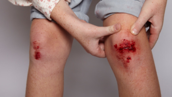 Tétanos e infecciones: por qué es clave completar el calendario de vacunación