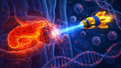 Cáncer de páncreas: 