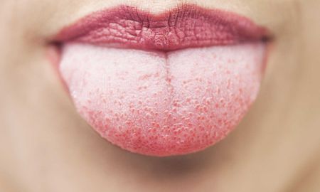 si tenes la lengua blanca, podes tener alguno de estos problemas de salud si tenes la lengua blanca, podes tener alguno de estos problemas de salud