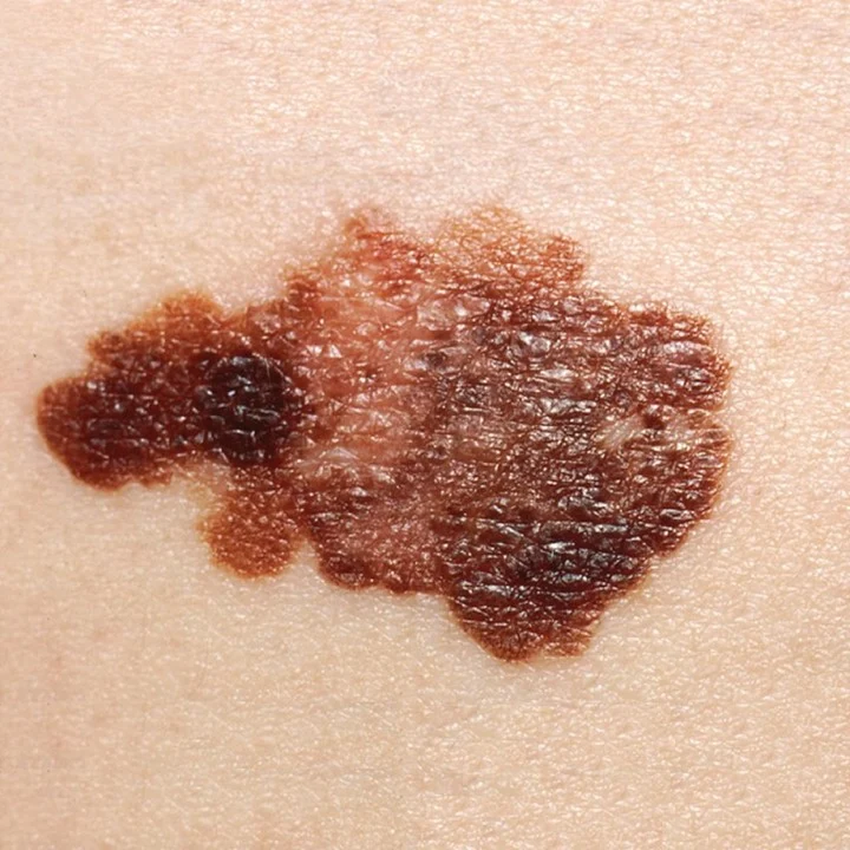 Lunar. Un melanoma en la piel de un paciente. Foto ilustrativa &nbsp;