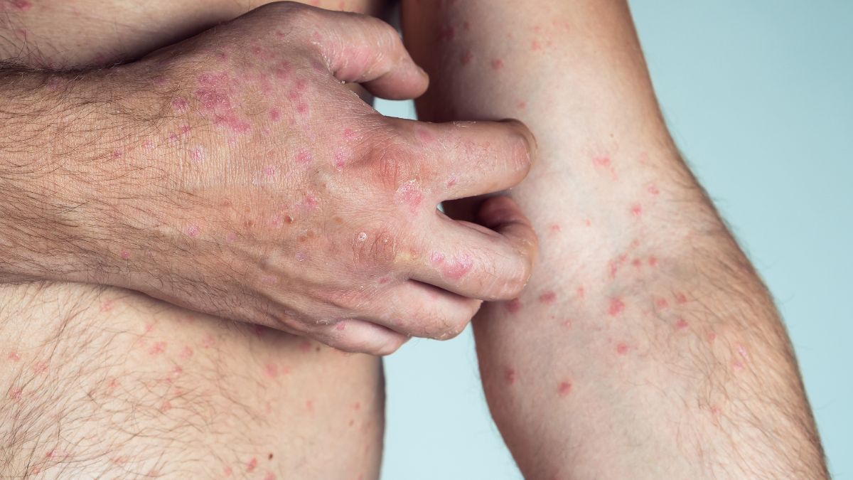 El caso confirmado de sarampión reaviva la importancia de la vacuna triple viral.