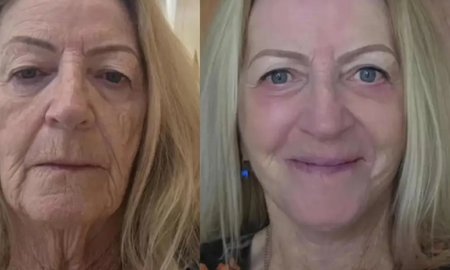 A los 73 años se hizo un lifting facial en Tailandia, rejuveneció 20 años. A los 73 años se hizo un lifting facial en Tailandia, rejuveneció 20 años.