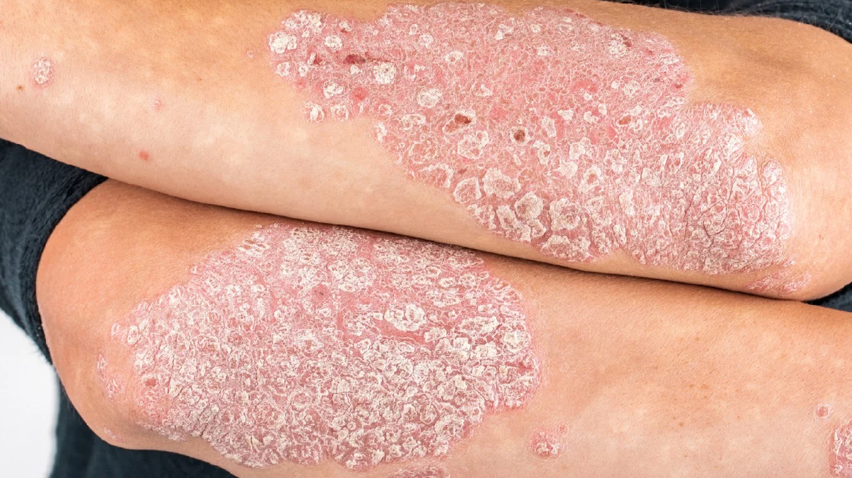 3 de cada 10 personas con psoriasis puede desarrollar adem&aacute;s artritis psori&aacute;sica.