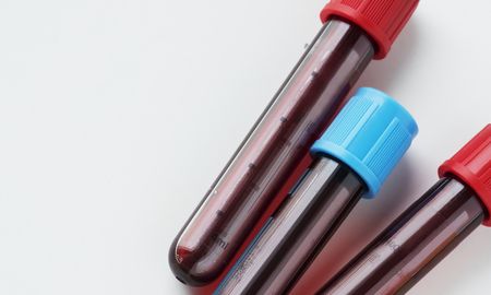 prueban un test de sangre para detectar cancer antes de que aparezcan sintomas prueban un test de sangre para detectar cancer antes de que aparezcan sintomas