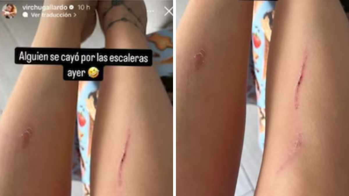 Virginia Gallardo mostró sus piernas con heridas y preocupó a sus seguidores. Virginia Gallardo mostró sus piernas con heridas y preocupó a sus seguidores.