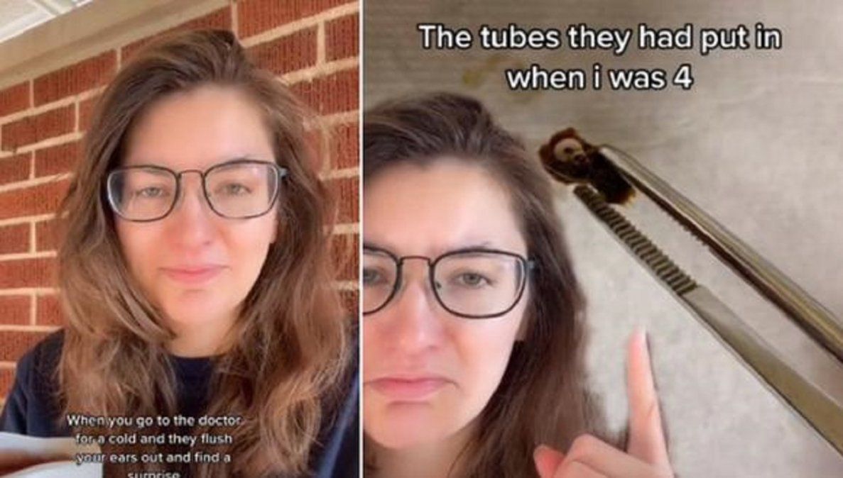 Video viral: a una joven le limpiaron los oídos y le encontraron un objeto de hace más de 20 años.