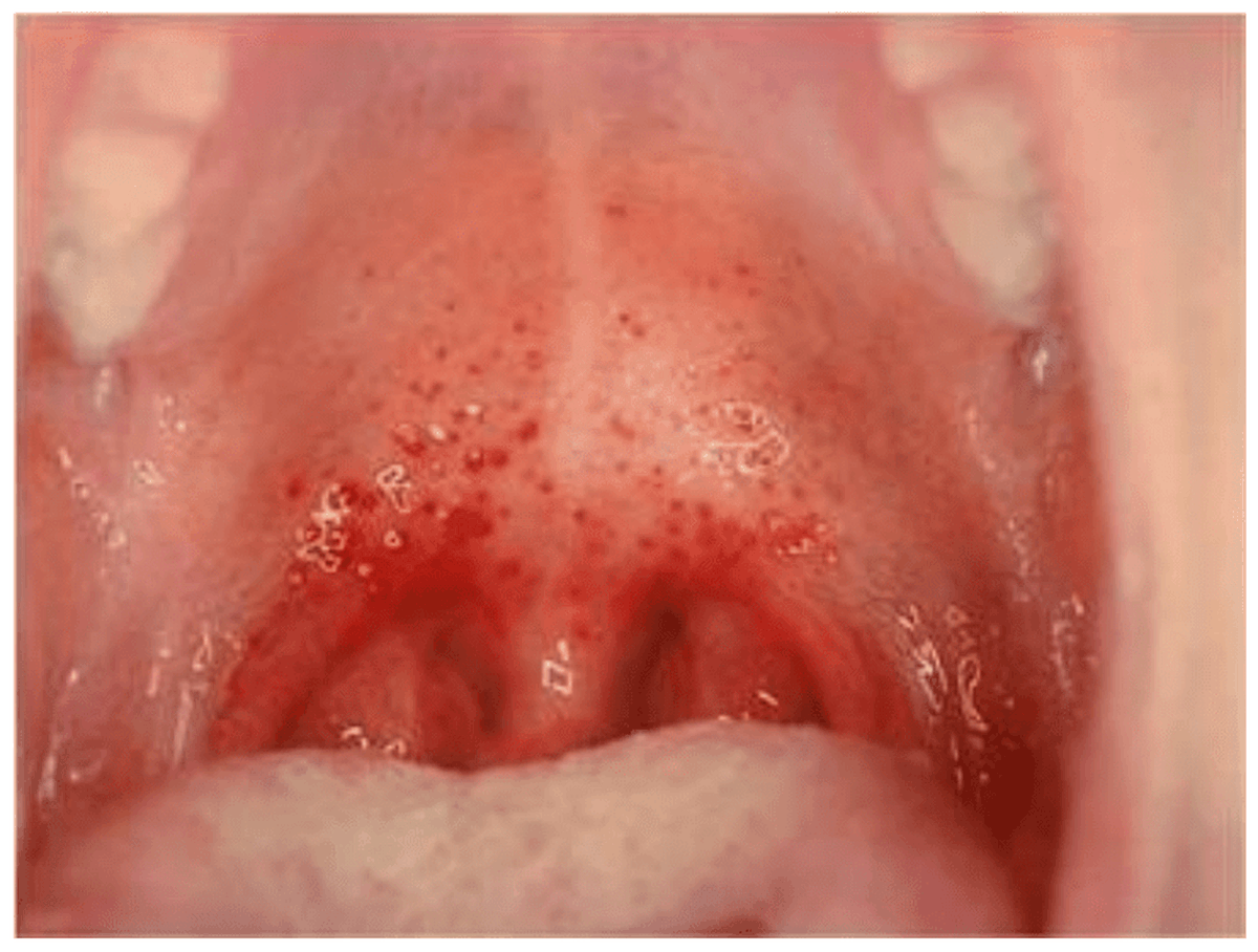 Infección en la garganta por Streptococcus Pyogenes. Infección en la garganta por Streptococcus Pyogenes.