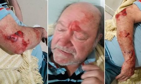 Las heridas del jubilado asaltado en su vivienda el fin de semana pasado. Las heridas del jubilado asaltado en su vivienda el fin de semana pasado.