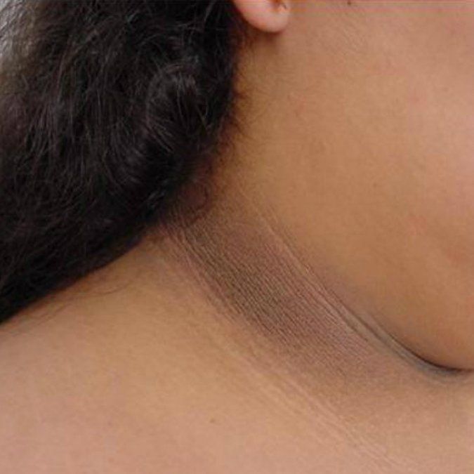 Por qué te salen manchas negras cuando tenés diabetes u otras enfermedades.