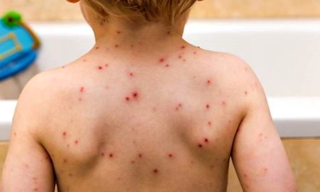 brote de sarampion: ?quienes no sepan si estan vacunados, que se apliquen la dosis?, pide salud brote de sarampion: ?quienes no sepan si estan vacunados, que se apliquen la dosis?, pide salud