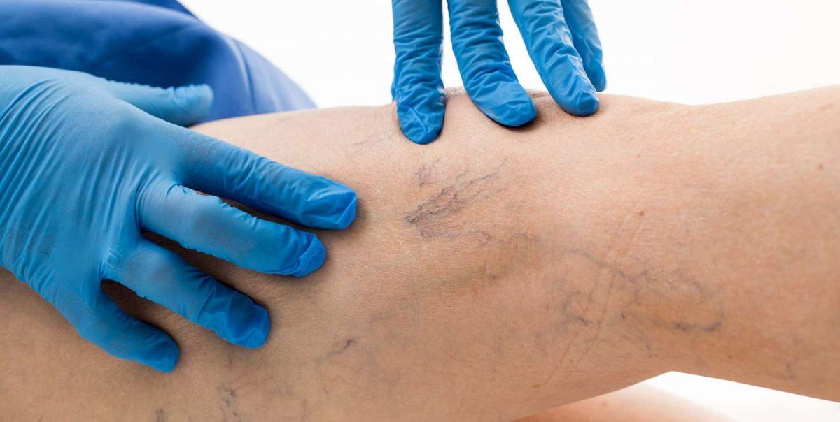 Varices en las piernas.