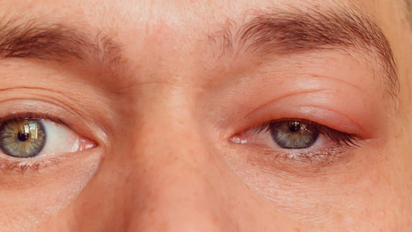 Cómo curar un orzuelo en casa de forma rápida y efectiva