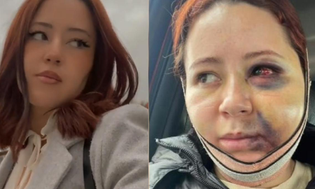 Se hizo una bichectomía en una estética y terminó con la cara desfigurada Se hizo una bichectomía en una estética y terminó con la cara desfigurada