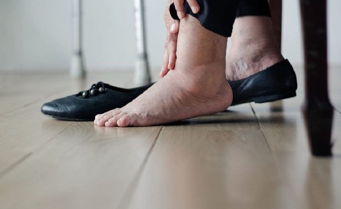 Cómo eliminar la hinchazón de pies