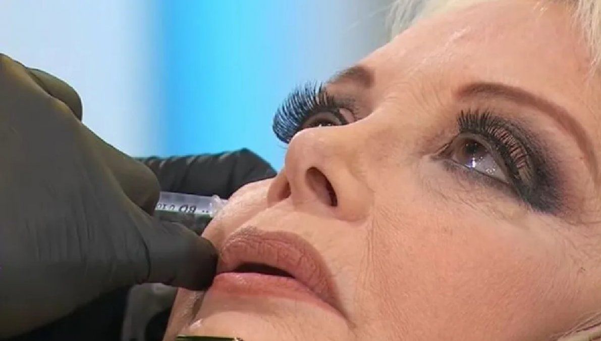 Carmen Barbieri se aplicó botox en vivo: el video