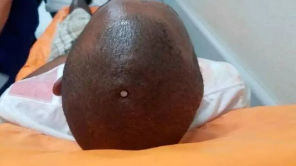 Un hombre se incrustó un clavo en la cabeza porque sentía flojo su cerebro