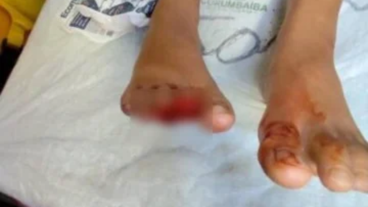 Niño de 9 años es atacado por pirañas en Caldas Novas - (crédito: Material cedido a Correio) Niño de 9 años es atacado por pirañas en Caldas Novas - (crédito: Material cedido a Correio)
