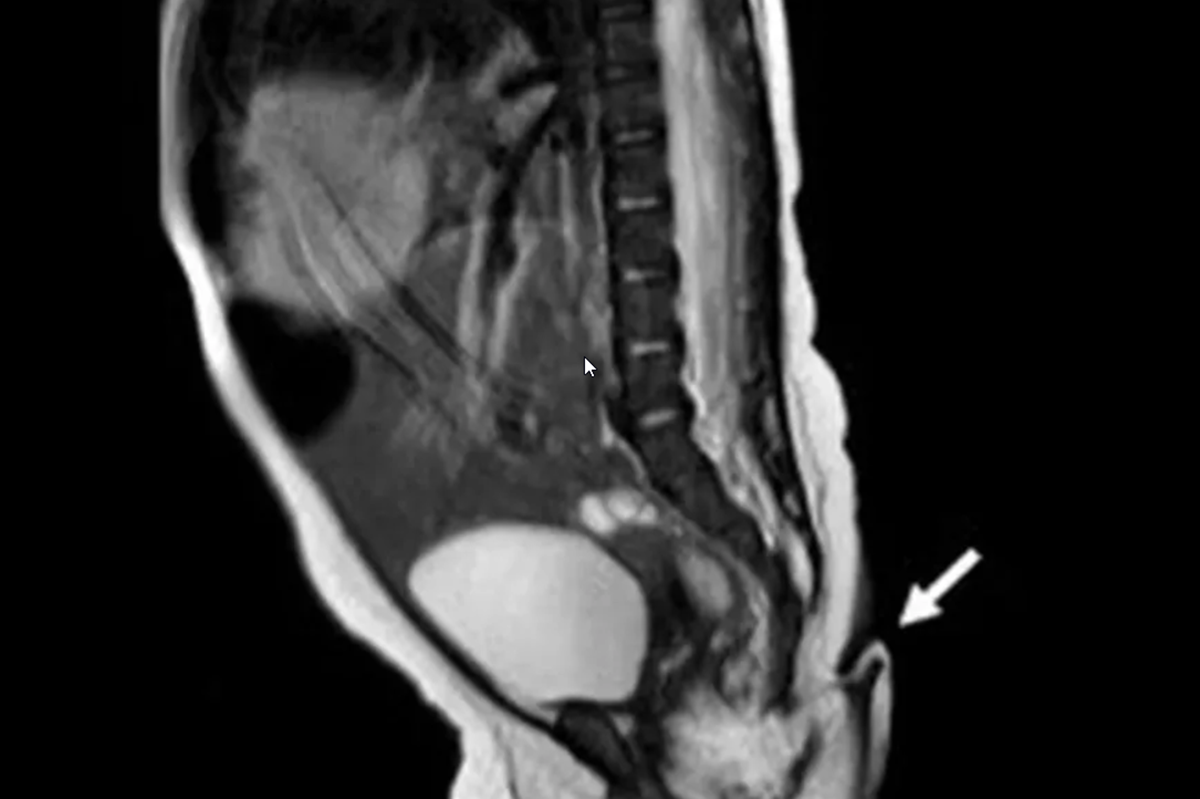 En el estado de Nuevo León, en México, ocurrió un caso de que generó el interés del mundo científico.