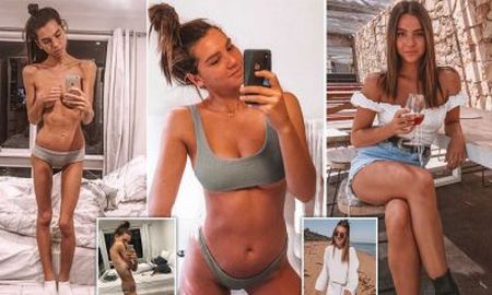 Terminó con anorexia por comer solo brócoli y gaseosas light