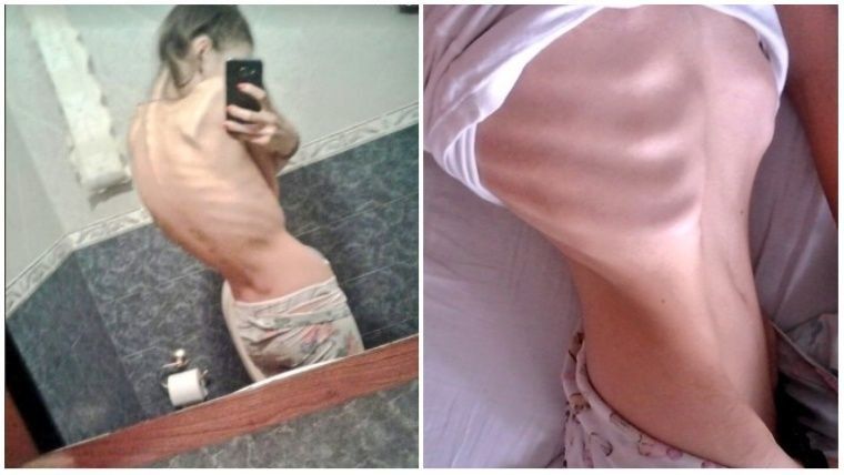 Las impactantes fotos de una adolescente que lucha contra la anorexia