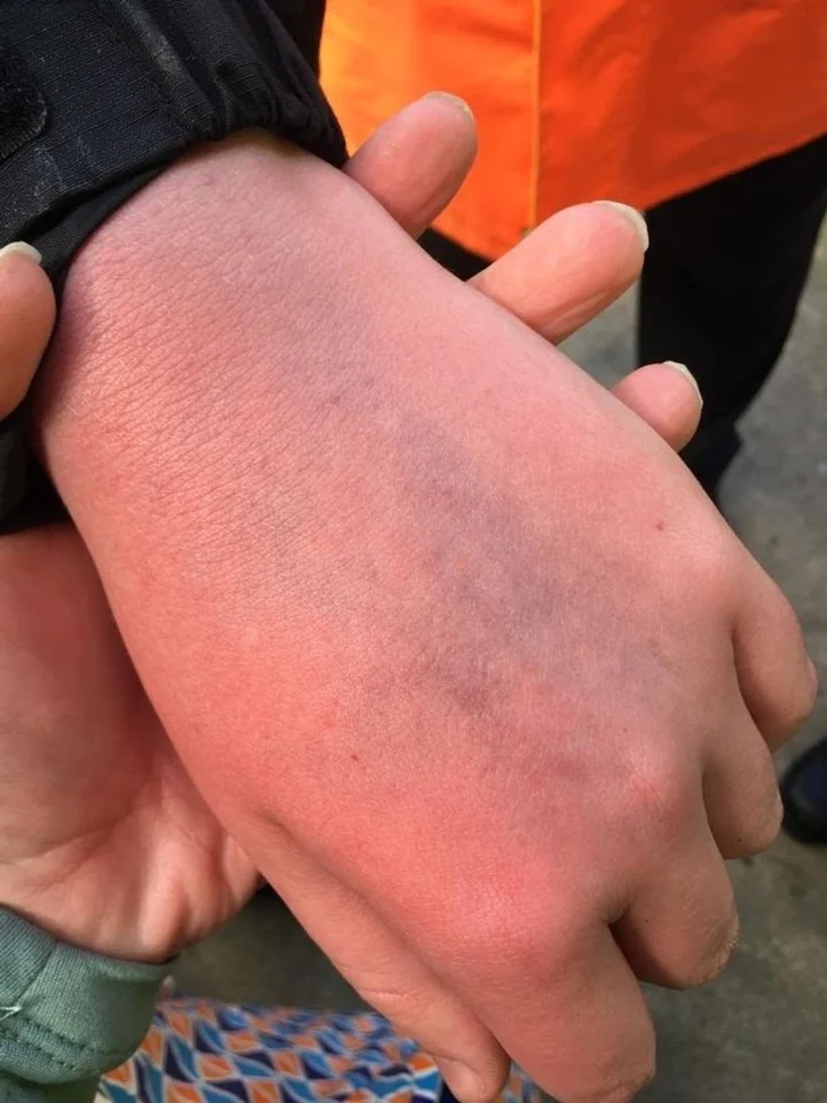 Así quedó la mano de Jake.