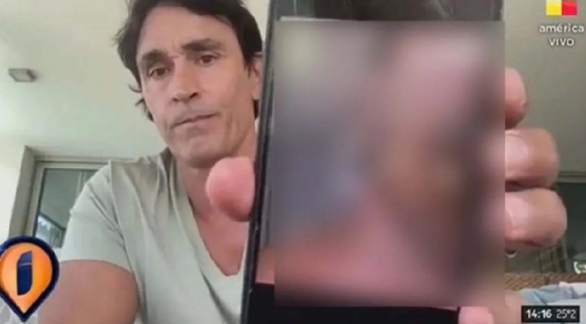 Sebastián Estevanez mostró las fotos de su cara quemada