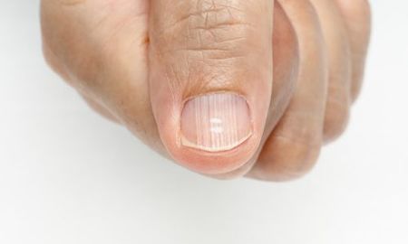 Las líneas verticales y horizontales en las uñas pueden indicar anemia y falta de vitaminas