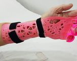 Las férulas ortopédicas termoformadas se producen mediante impresión 3D. Los detalles de la campaña solidaria en Santa Fe. Las férulas ortopédicas termoformadas se producen mediante impresión 3D. Los detalles de la campaña solidaria en Santa Fe.