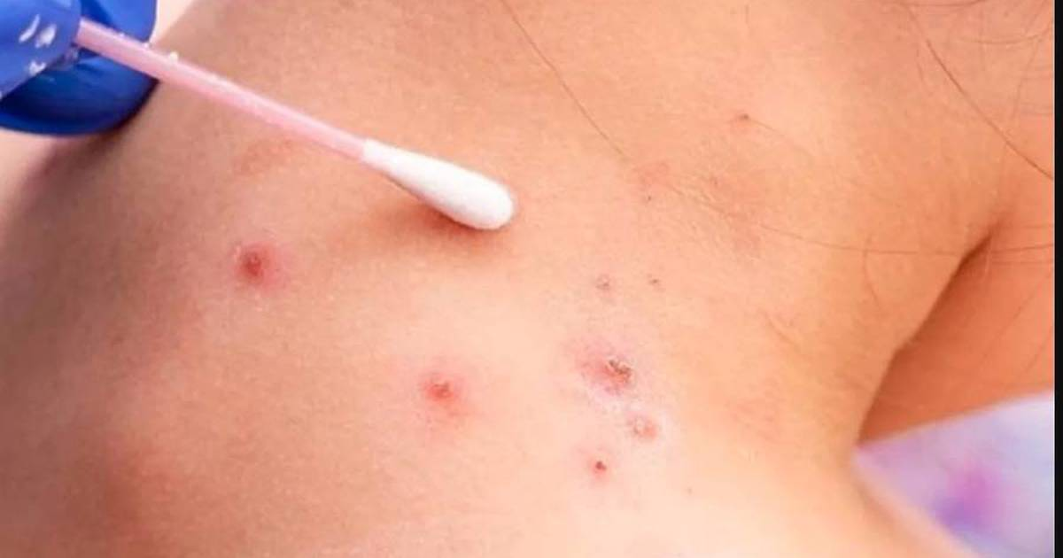 Las muestras sospechosas de viruela símica se toman hisopando directamente en las lesiones de la piel.