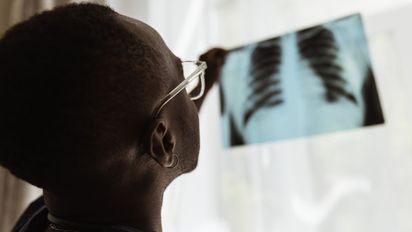 Tuberculosis: el 85% de los pacientes se cura, pero el subdiagnóstico es una amenaza silenciosa