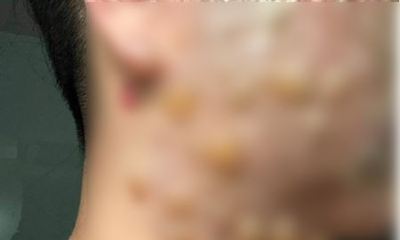 Le quemaron el rostro “de adentro hacia afuera” en un tratamiento para estimular el colágeno