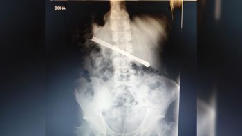 Insólito: un preso sufría dolores abdominales y descubrieron una bombilla en su estómago